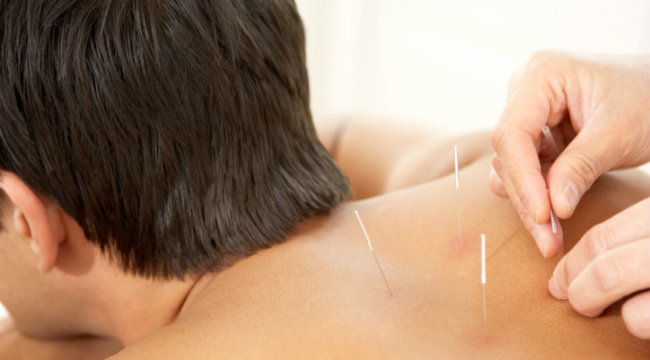 Accupuncture.jpg